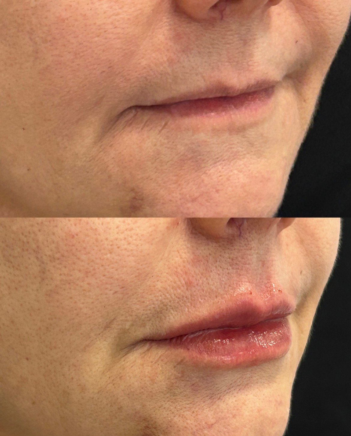 Antes e depois de preenchimento labial