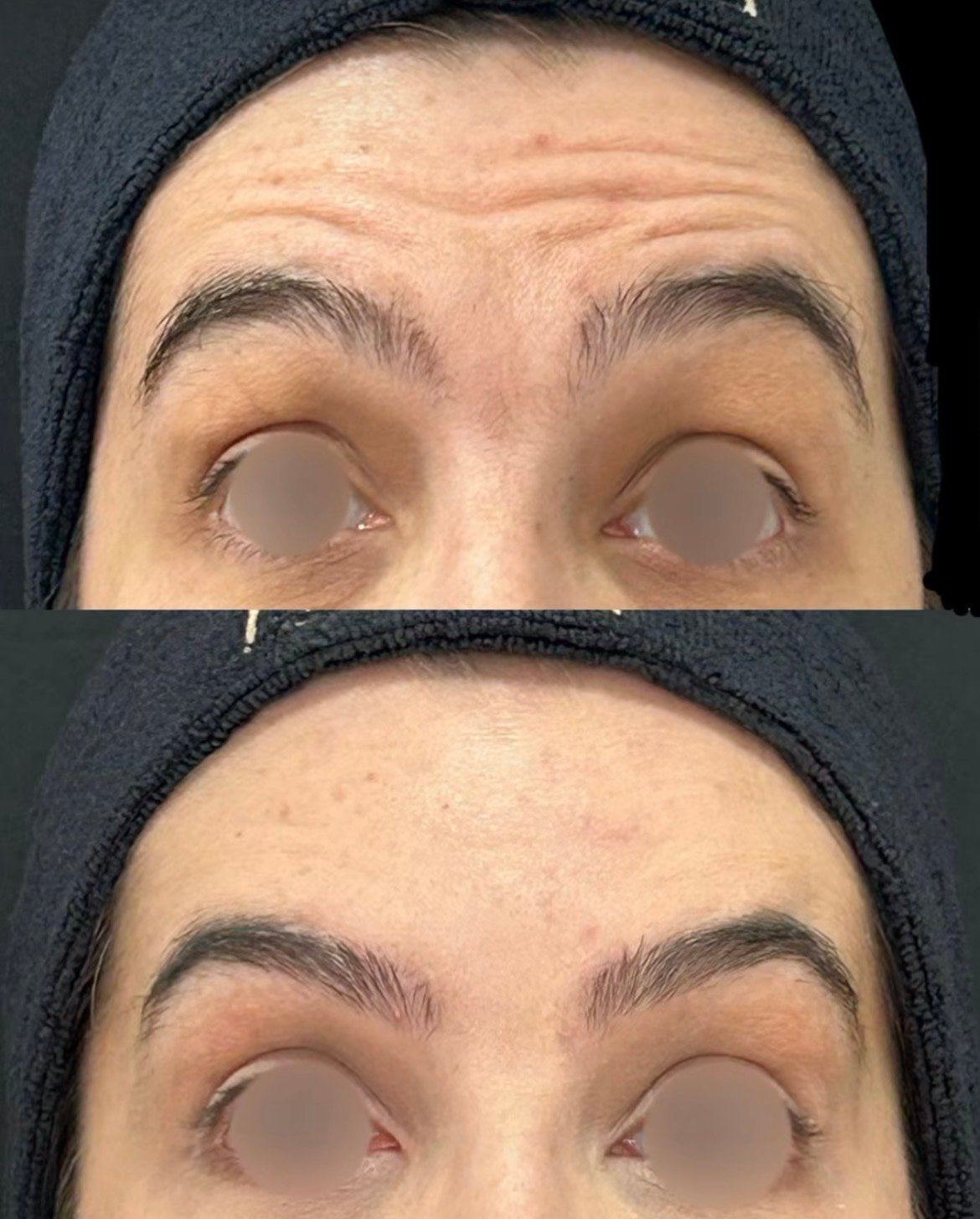 Antes e depois de toxina botulínica