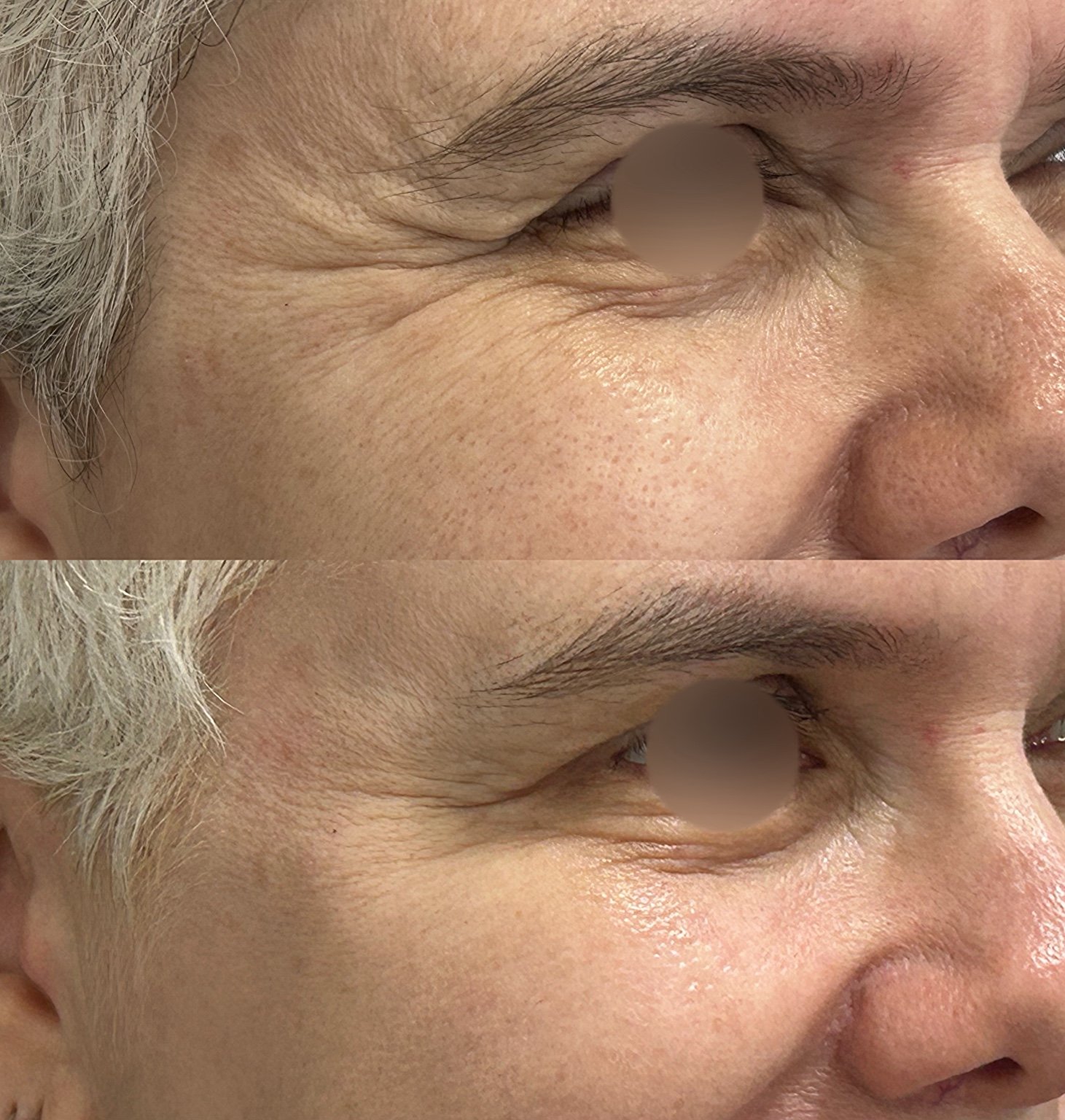 Antes e depois de toxina botulínica em paciente masculino